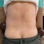 【腰痛・ぎっくり腰には、パルス鍼×骨盤矯正（AKA・SCJM）が根本改善への近道】